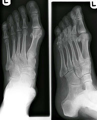 joints How to End Joint Pain <em>Without</em> Medication